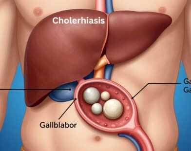 Cholerhiasis: Causes, Symptoms, and Treatment Guide